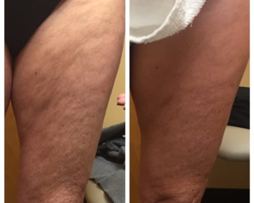 3 Leg B&F