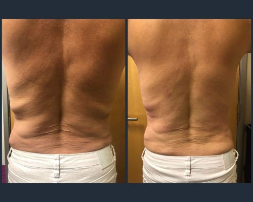 Back_SkinTightening