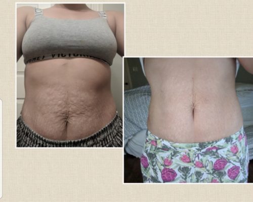 StretchMarks